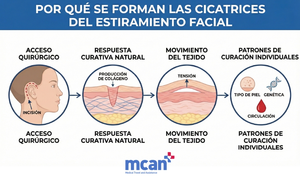 ¿Por qué se forman las cicatrices Lifting facial?