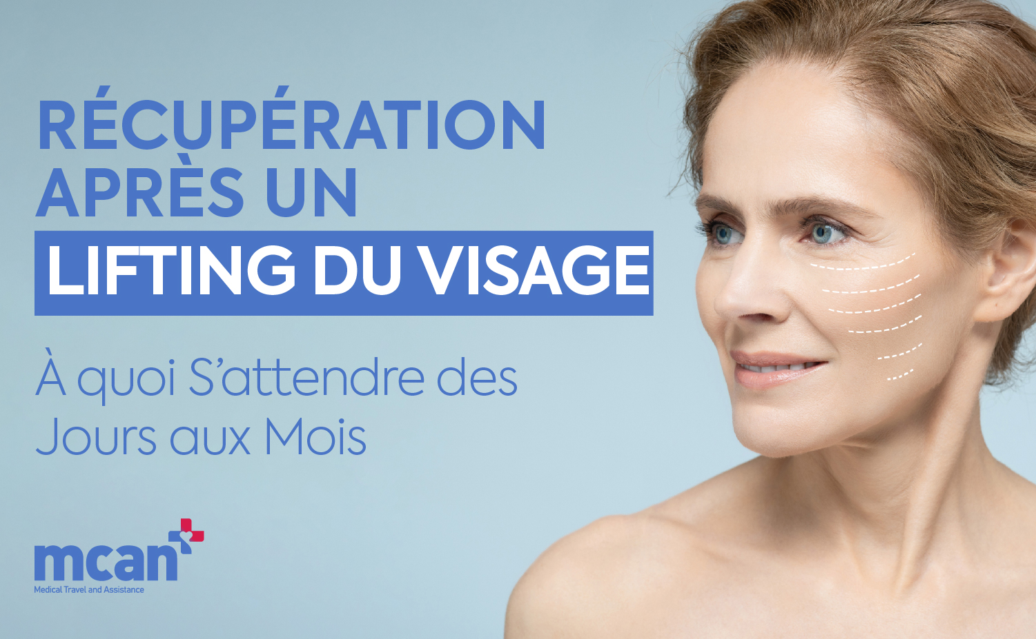 Récupération après un lifting du visage : à quoi s’attendre des jours aux mois