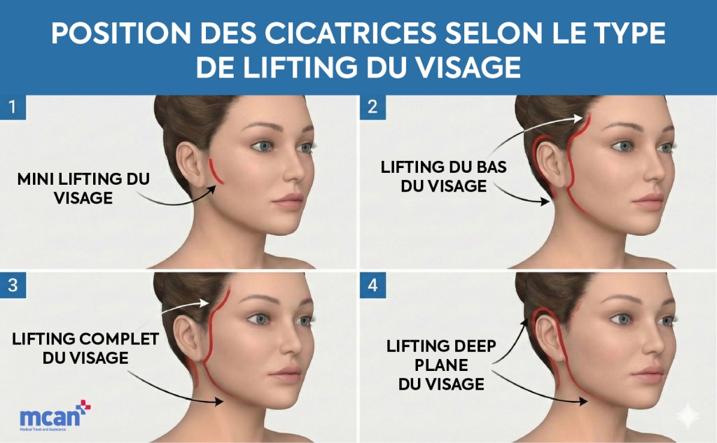 Placement des cicatrices selon le type de lifting