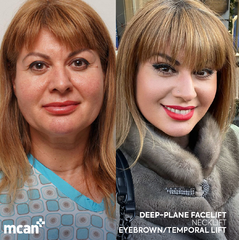 Facelift Scars and Recovery Support in Turkey with MCAN Health