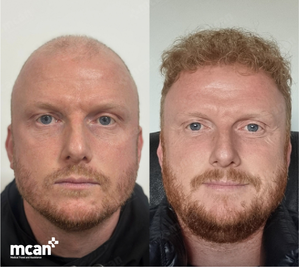 Hair Transplant Cost Planning in Turkey With MCAN Health