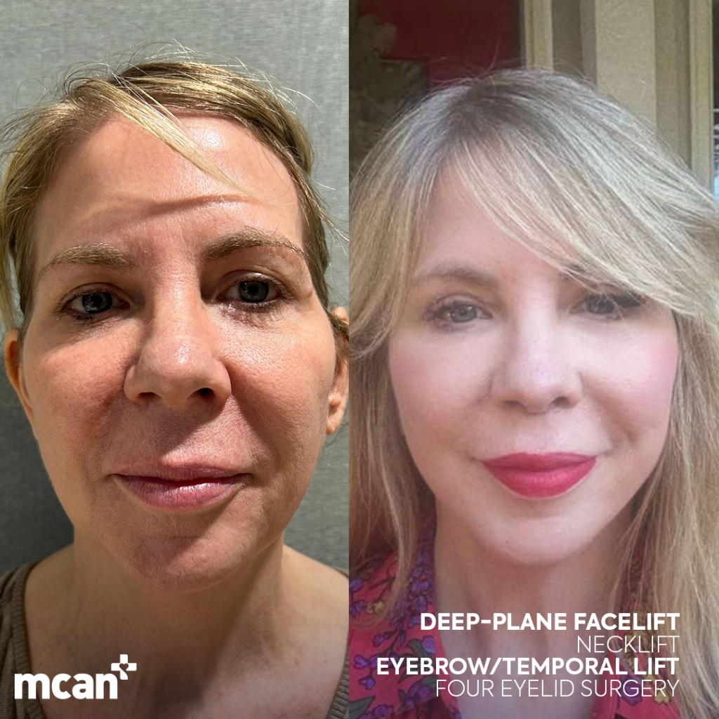 Facelift in Turkey 9 Jennifer Beaudoin Jennifer Beaudoin