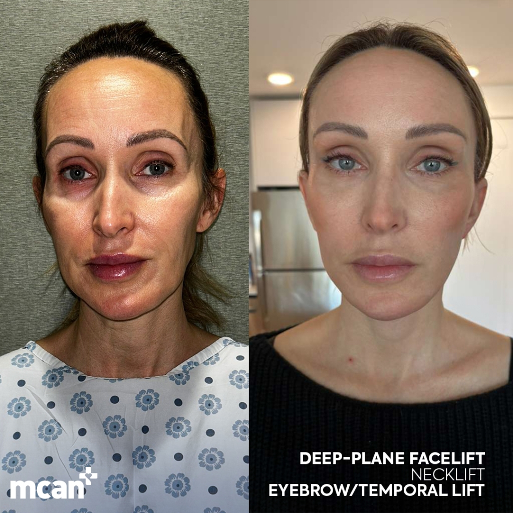 Facelift in Turkey 7 Karine Boulianne Karine Boulianne