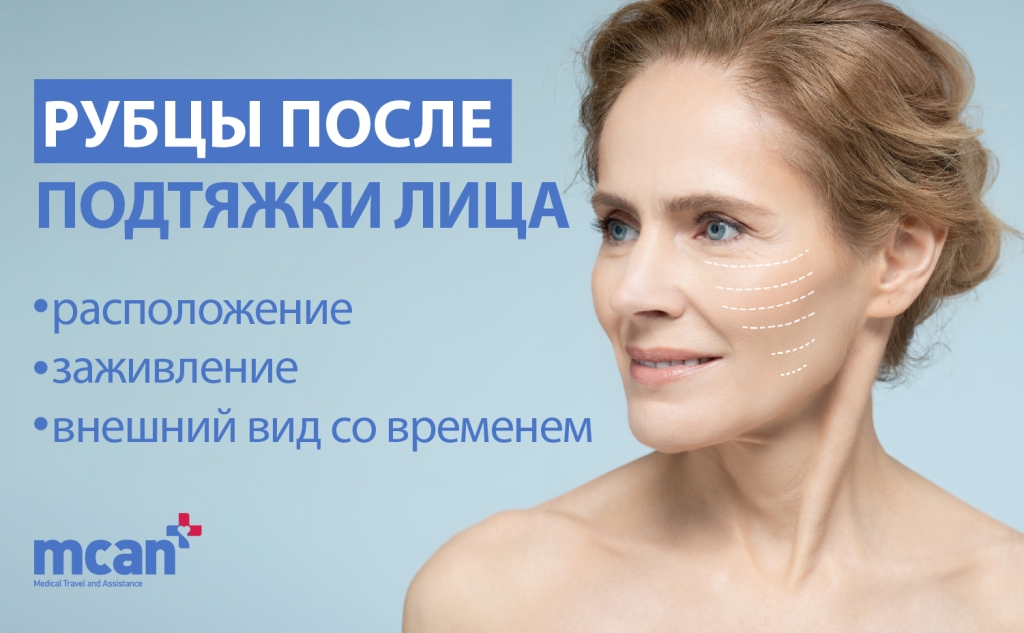 Рубцы после подтяжки лица: расположение, заживление и внешний вид со временем