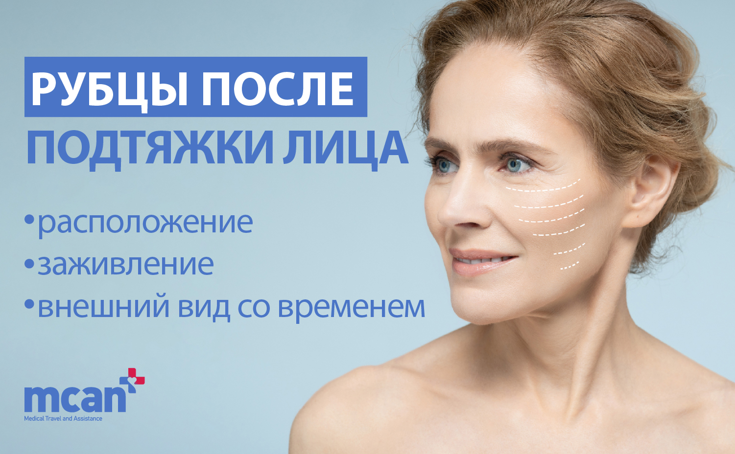 Рубцы после подтяжки лица: расположение, заживление и внешний вид со временем