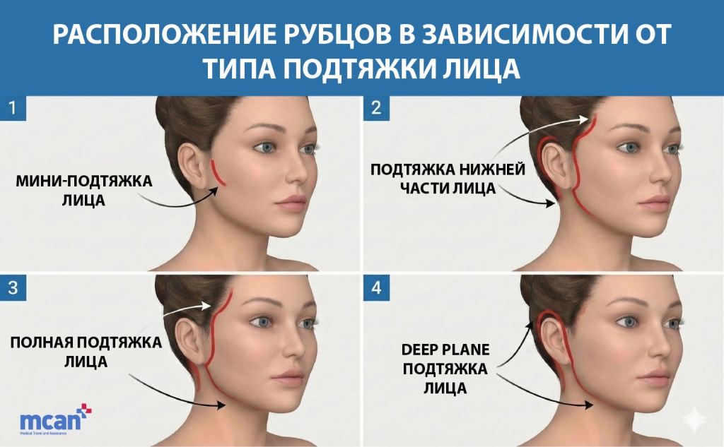 Расположение рубцов при подтяжке лица в зависимости от типа подтяжки лица