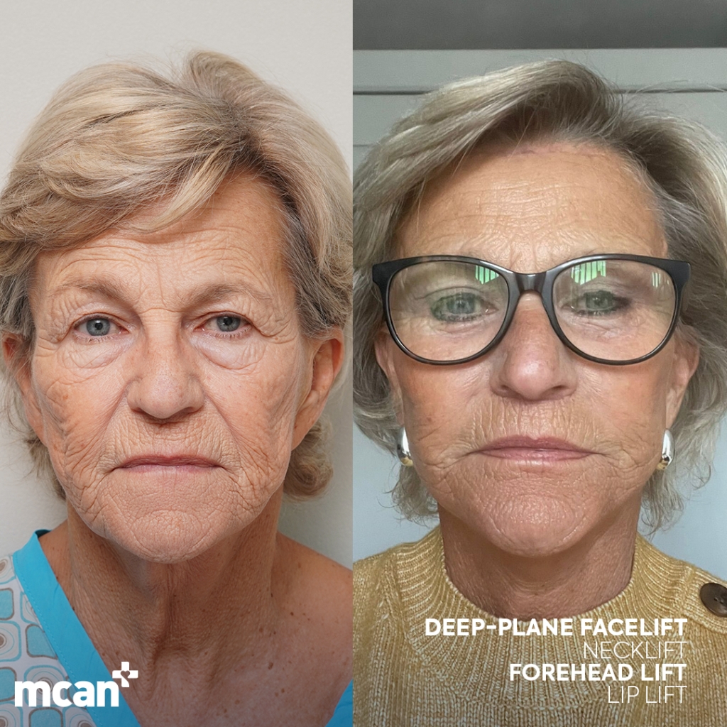 Facelift in Turkey 13 Susan Nicholson Susan Nicholson