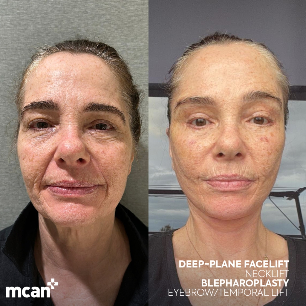 Facelift in Turkey 21 debra debra