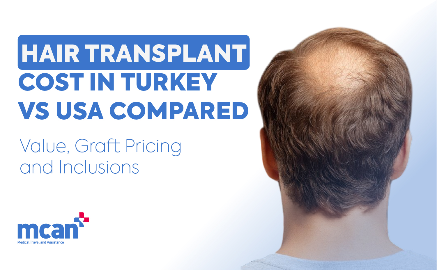en Hair Transplant Cost in Turkey vs USA Compared