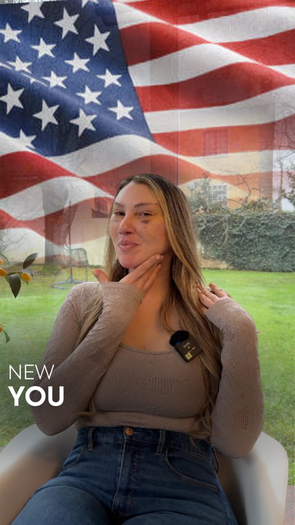 Facelift in Turkey 34 facelift story 3 1 facelift story 3 1