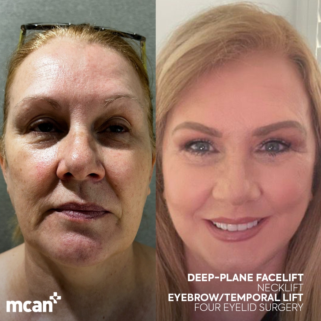 Facelift in Turkey 11 susan ehrke susan ehrke