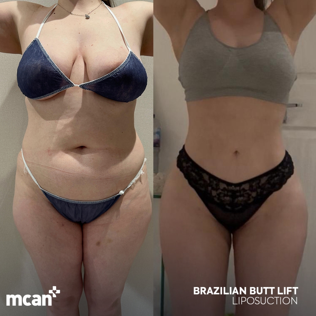 Liposuction Turkey 4 Carla Pinto Carla Pinto