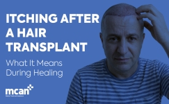 EN Itching After a Hair Transplant