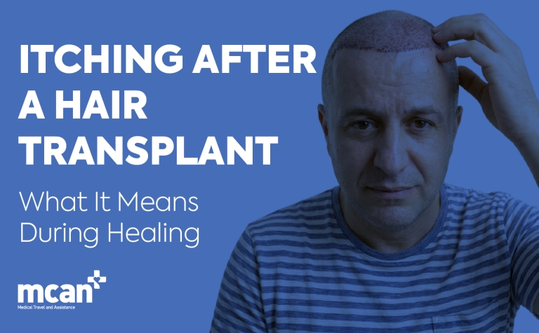 Itching After a Hair Transplant: What It Means During Healing