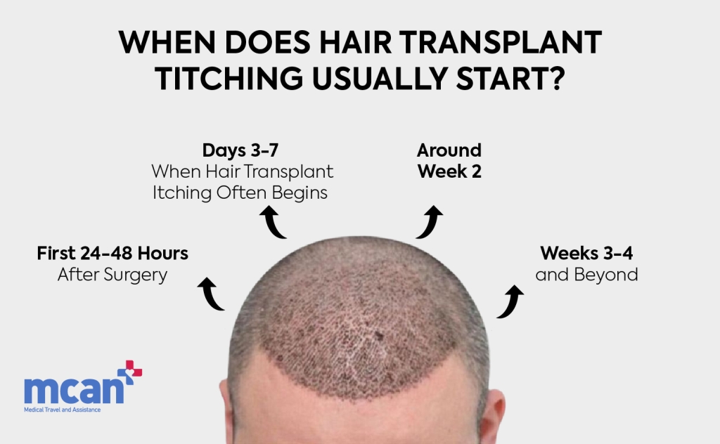 EN When Does Hair Transplant Itching Usually Start