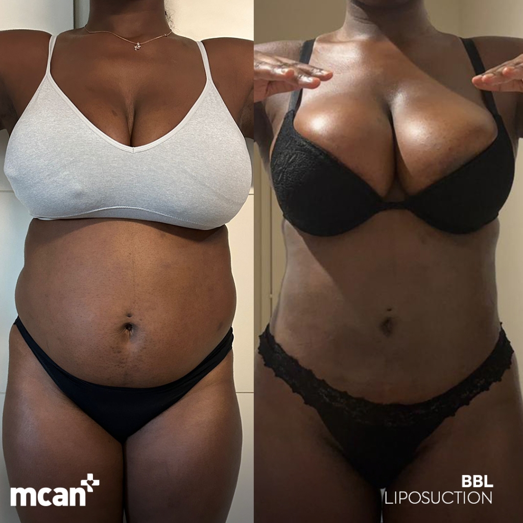 Liposuction Turkey 6 Emma nwachukwu Emma nwachukwu