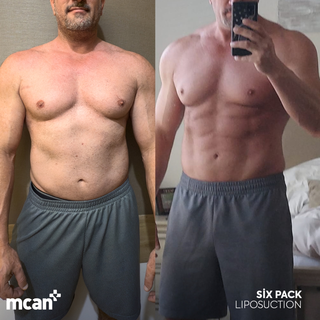 Liposuction Turkey 5 Jimmy Smith Jimmy Smith