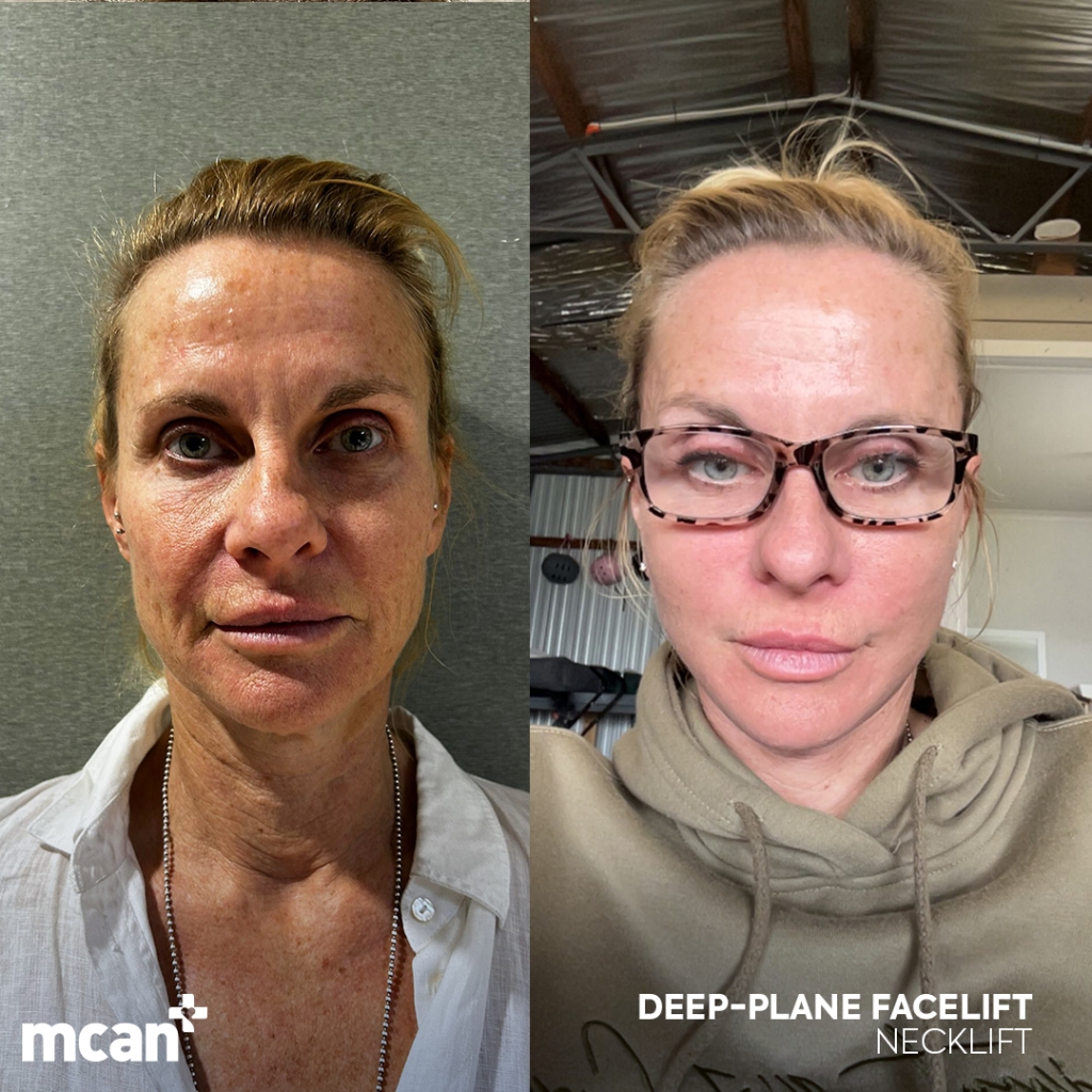 Facelift in Turkey 10 Kelly Murray Kelly Murray