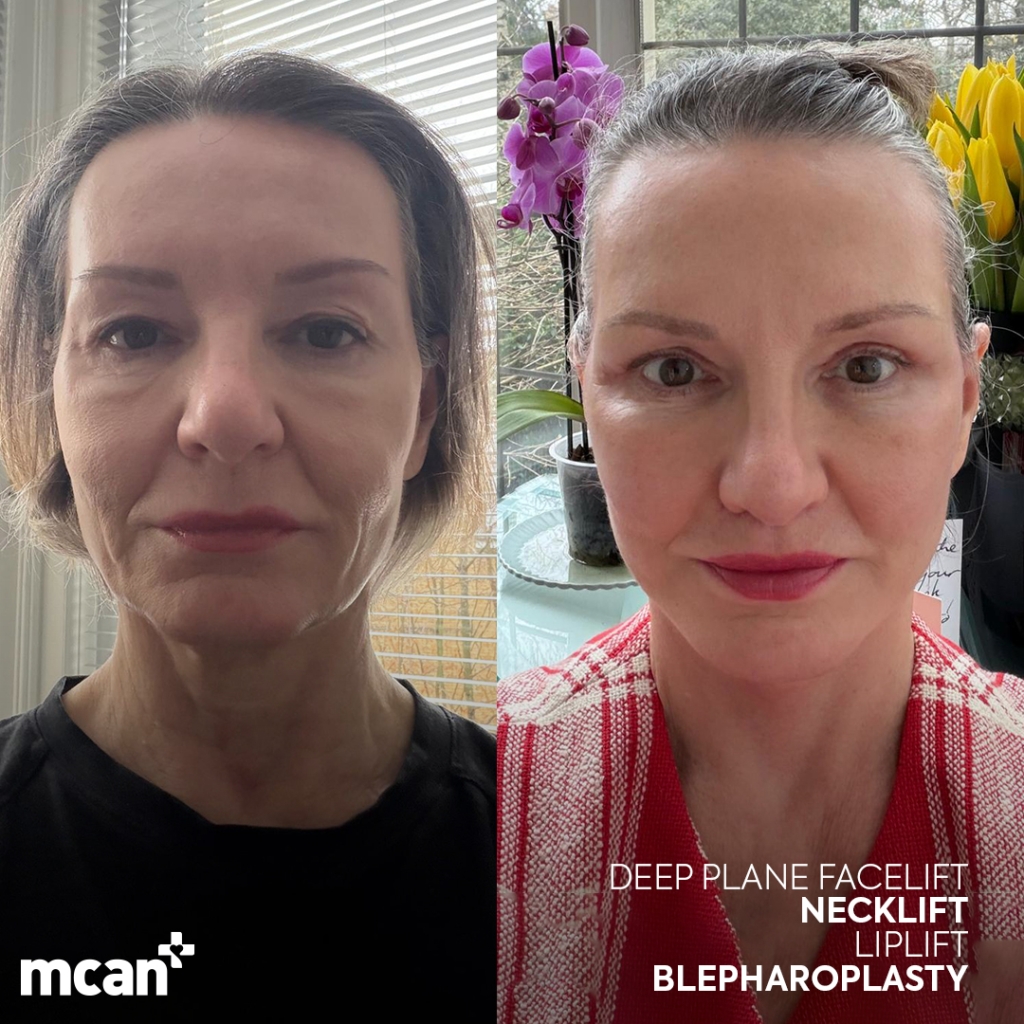 Facelift in Turkey 5 kim maher kim maher