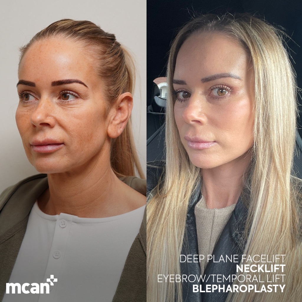 Facelift in Turkey 6 michelle oldfield michelle oldfield