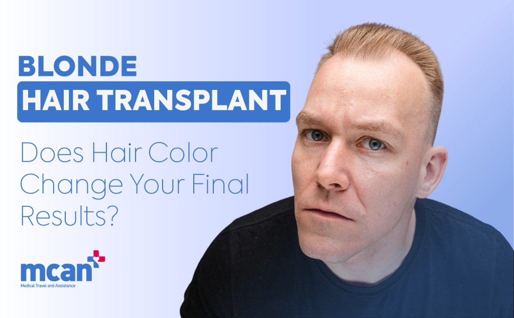 Blonde Hair Transplant: Does Hair Color Change Your Final Results? 1 Blonde Hair Transplant Blonde Hair Transplant