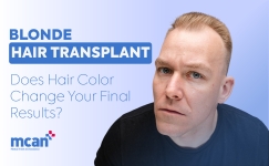 Blonde Hair Transplant