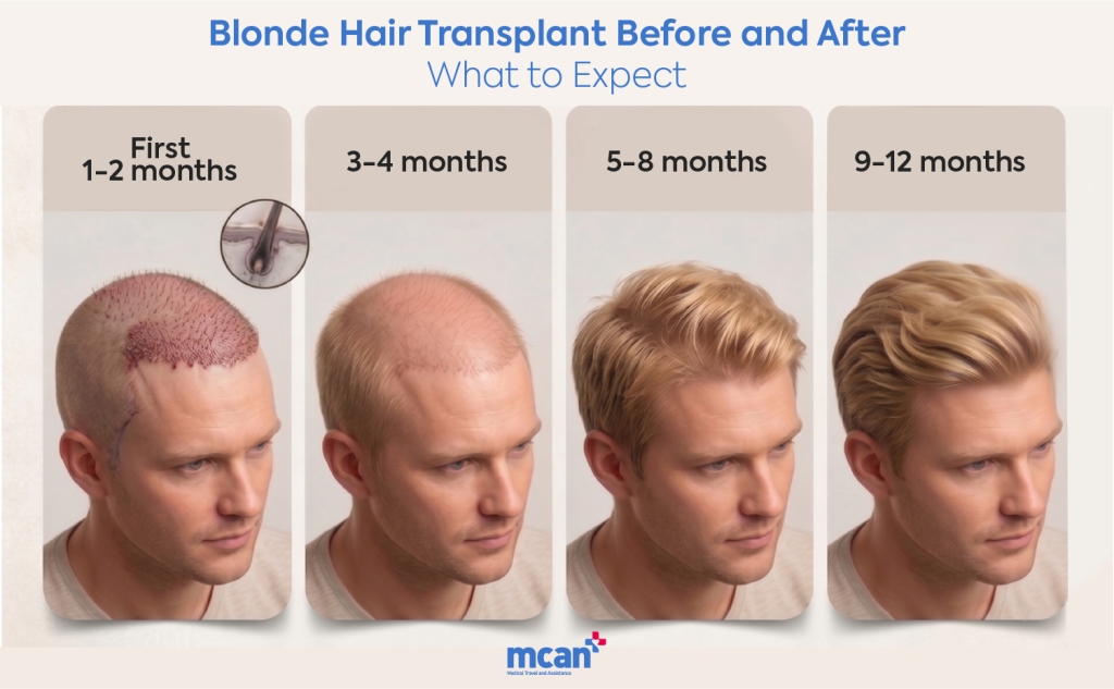Blonde Hair Transplant: Does Hair Color Change Your Final Results? 5 Blonde Hair Transplant Before and After What to Expect Blonde Hair Transplant Before and After What to Expect