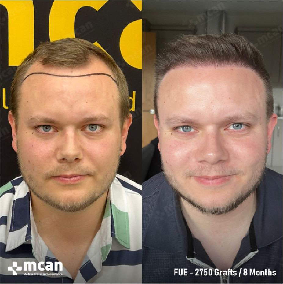 Blonde Hair Transplant: Does Hair Color Change Your Final Results? 6 Blonde Hair Transplant in Turkey with MCAN Health Blonde Hair Transplant in Turkey with MCAN Health