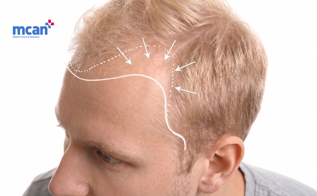 Blonde Hair Transplant: Does Hair Color Change Your Final Results? 4 Hairline Design in Blonde Hair Transplants Hairline Design in Blonde Hair Transplants
