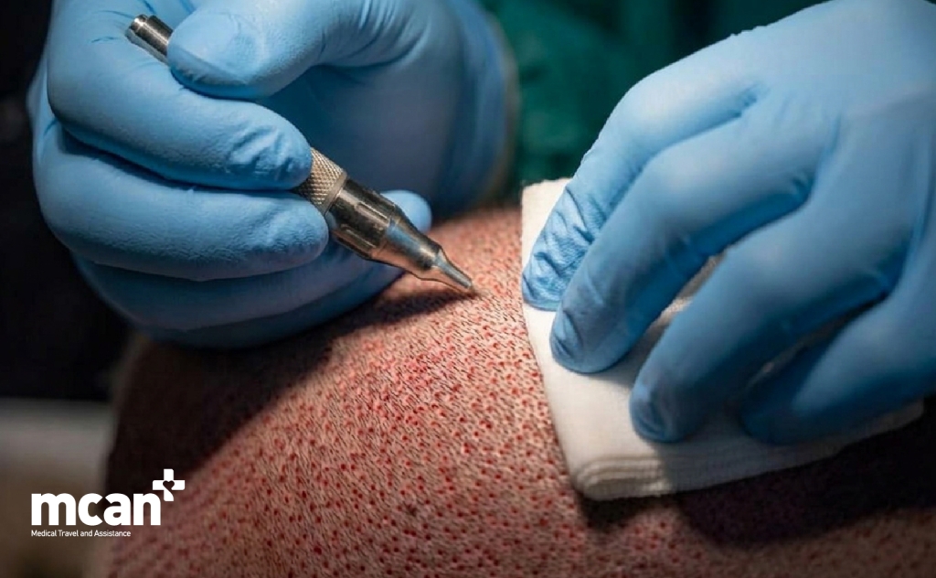 Why Hair Dye Timing Matters After a Hair Transplant