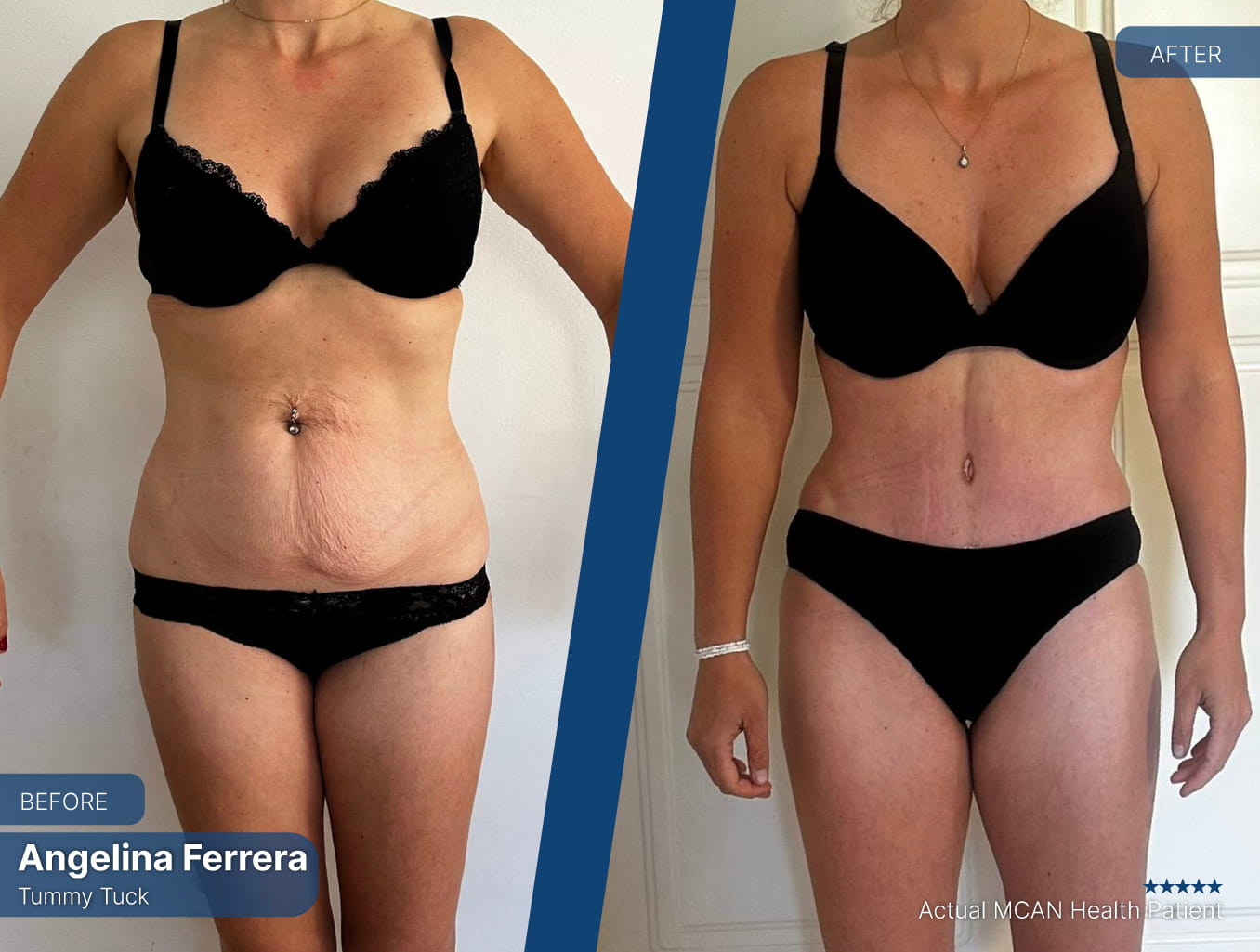 Before After 1