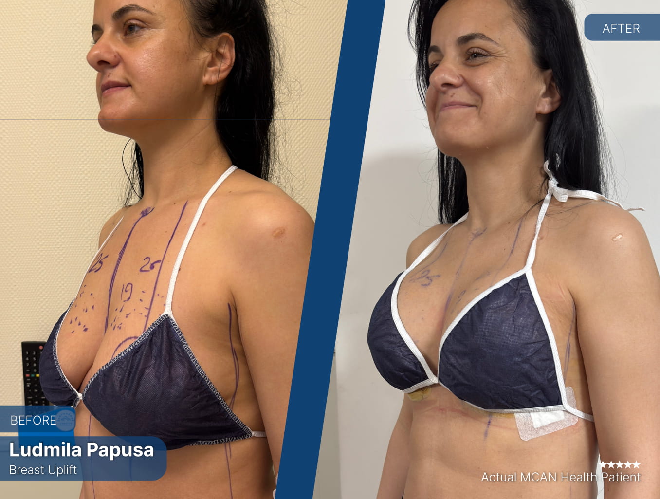 Before After 5