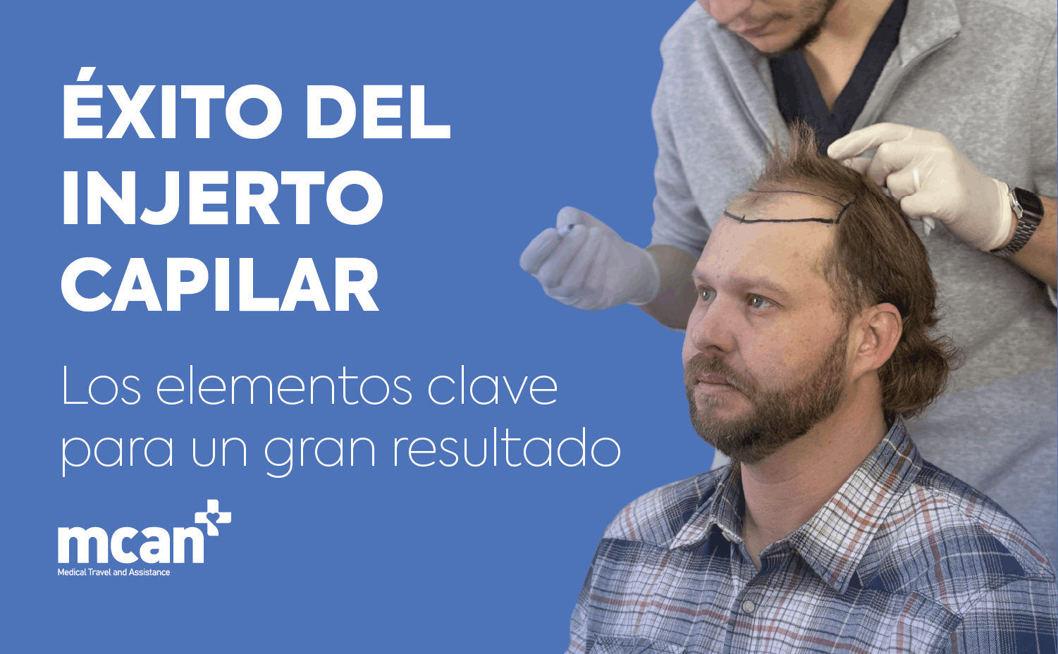 Éxito del injerto capilar: los elementos clave para un gran resultado 1 Hair Transplant Success nl Hair Transplant Success nl