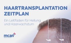 Hair Transplant Timeline de