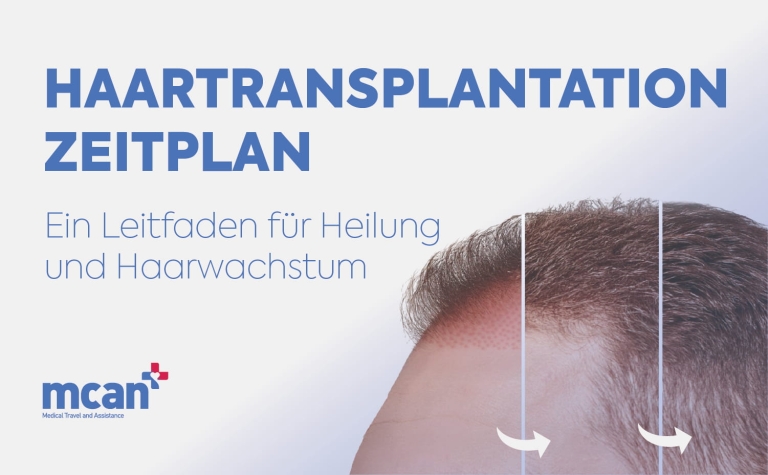 Haartransplantation Zeitplan: Ein Leitfaden für Heilung und Haarwachstum 3 Hair Transplant Timeline de Hair Transplant Timeline de