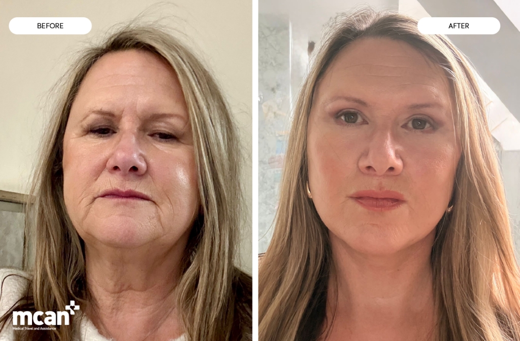 Neck Lift vs Facelift with MCAN Health A Structured Approach to Facial Balance
