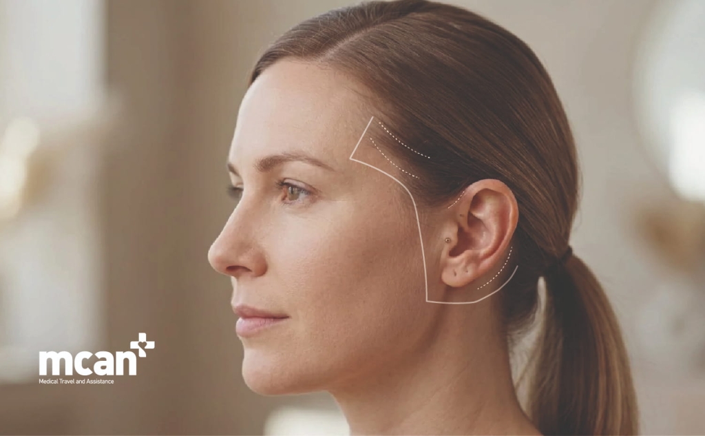 Ponytail Facelift: What the Technique Claims and What It Actually Delivers 4 Ponytail Facelift Recovery and Scars Ponytail Facelift Recovery and Scars