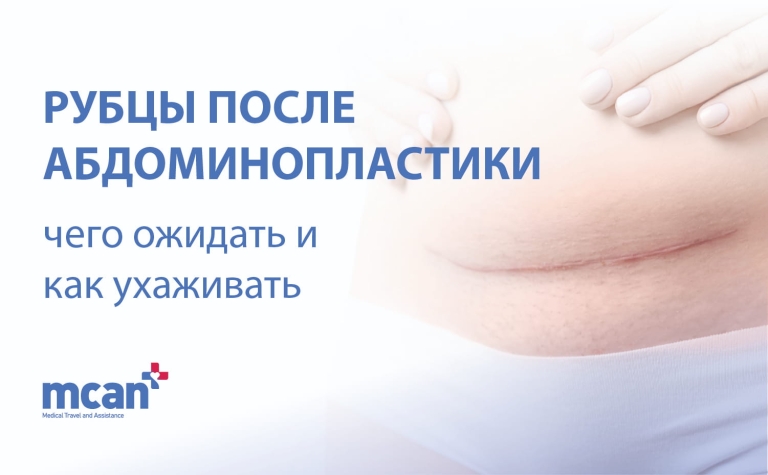 Рубцы после абдоминопластики: чего ожидать и как ухаживать 6 Tummy Tuck Scars RU Tummy Tuck Scars RU