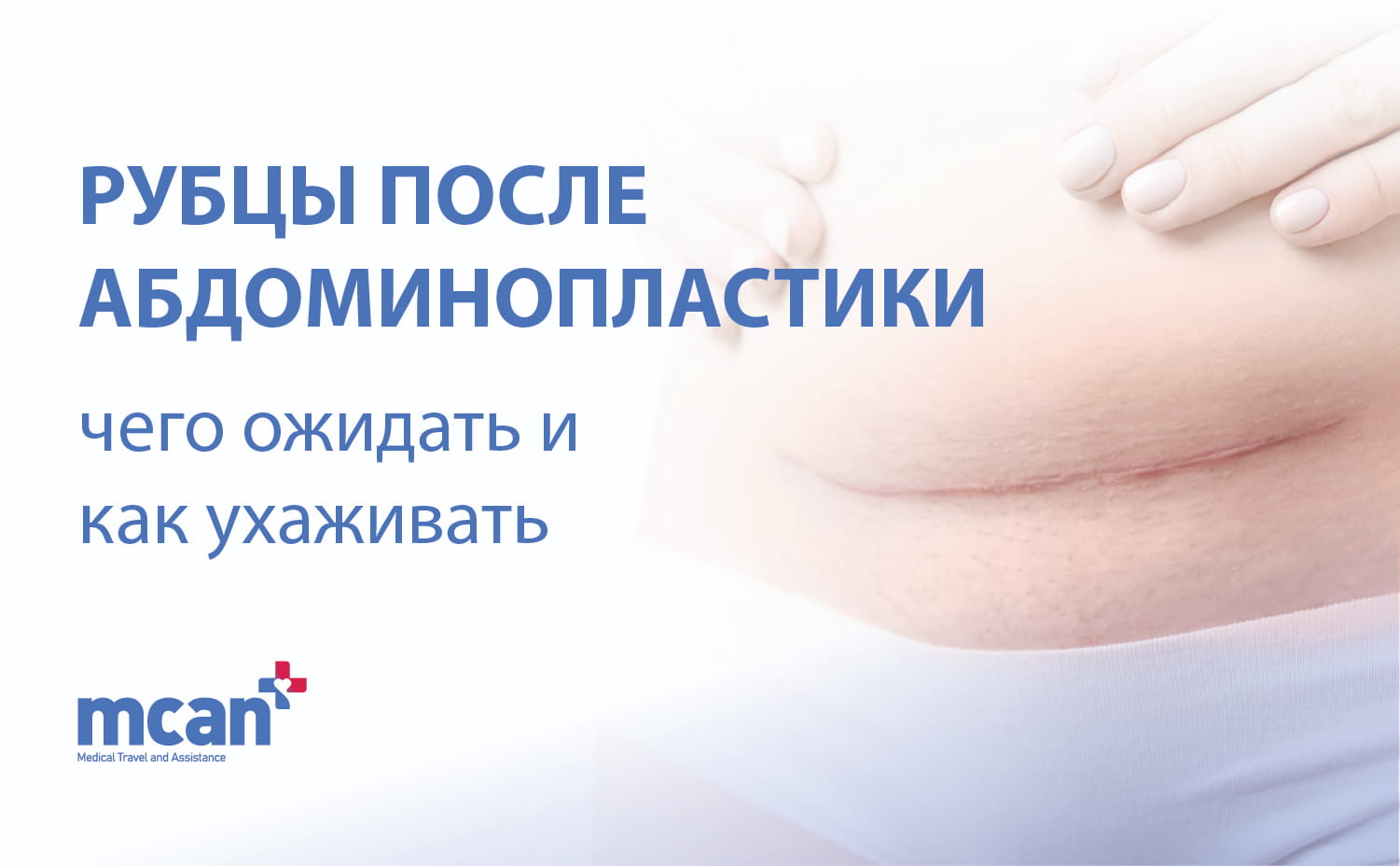 Рубцы после абдоминопластики: чего ожидать и как ухаживать 2 Tummy Tuck Scars RU Tummy Tuck Scars RU