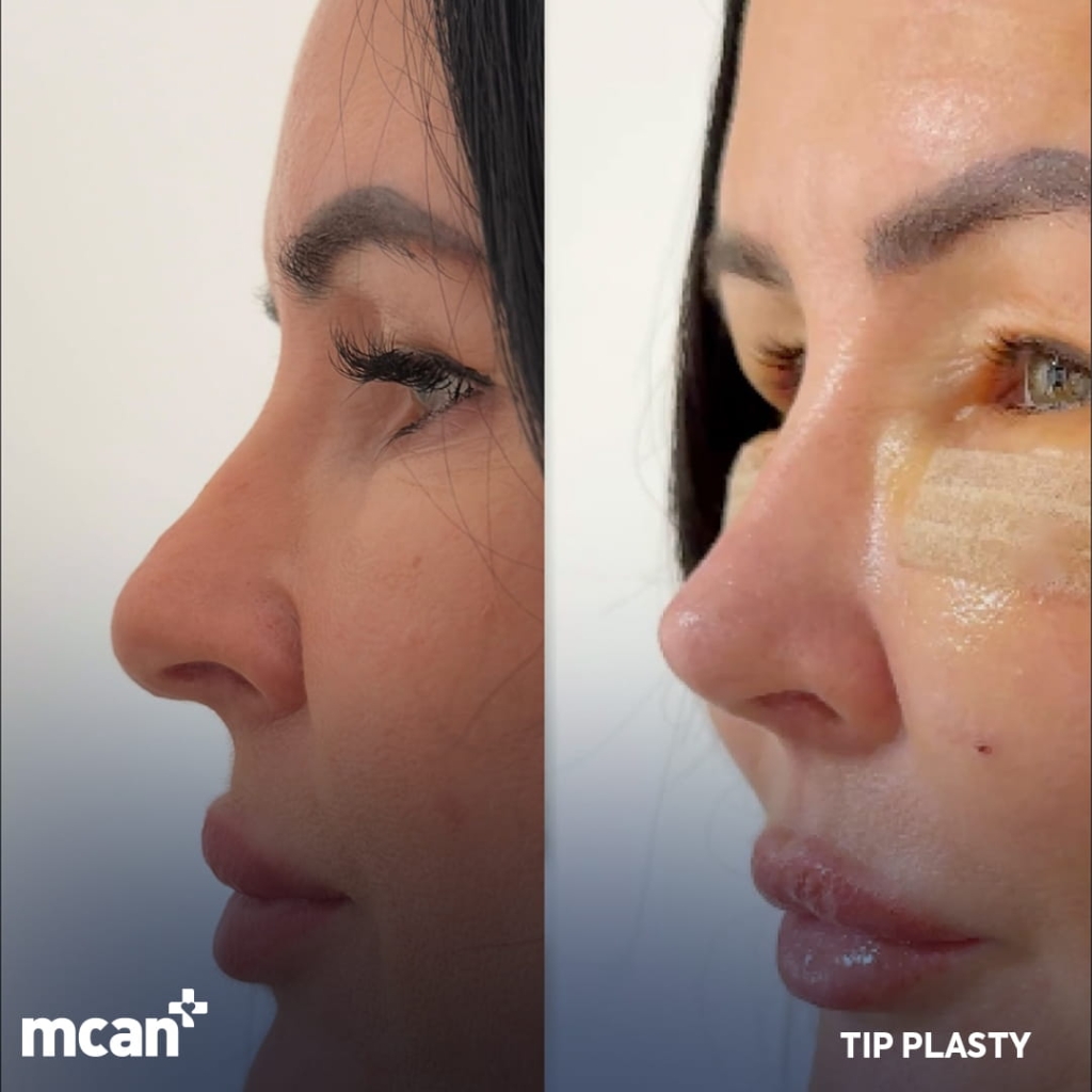 Rhinoplasty Turkey 8 1 1