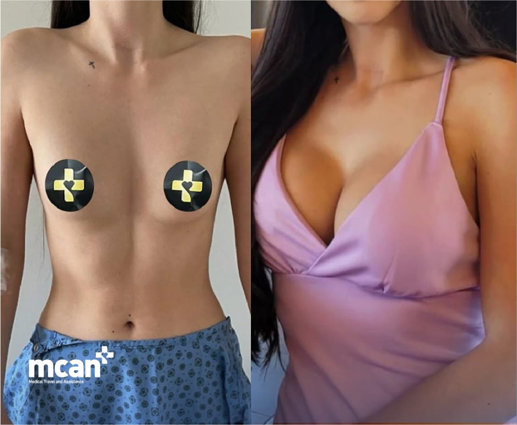 Dual Plane Breast Augmentation: Why Implant Placement Matters for Long-Term Results 4 Dual Plane Breast Augmentation Before and After 1 Dual Plane Breast Augmentation Before and After 1