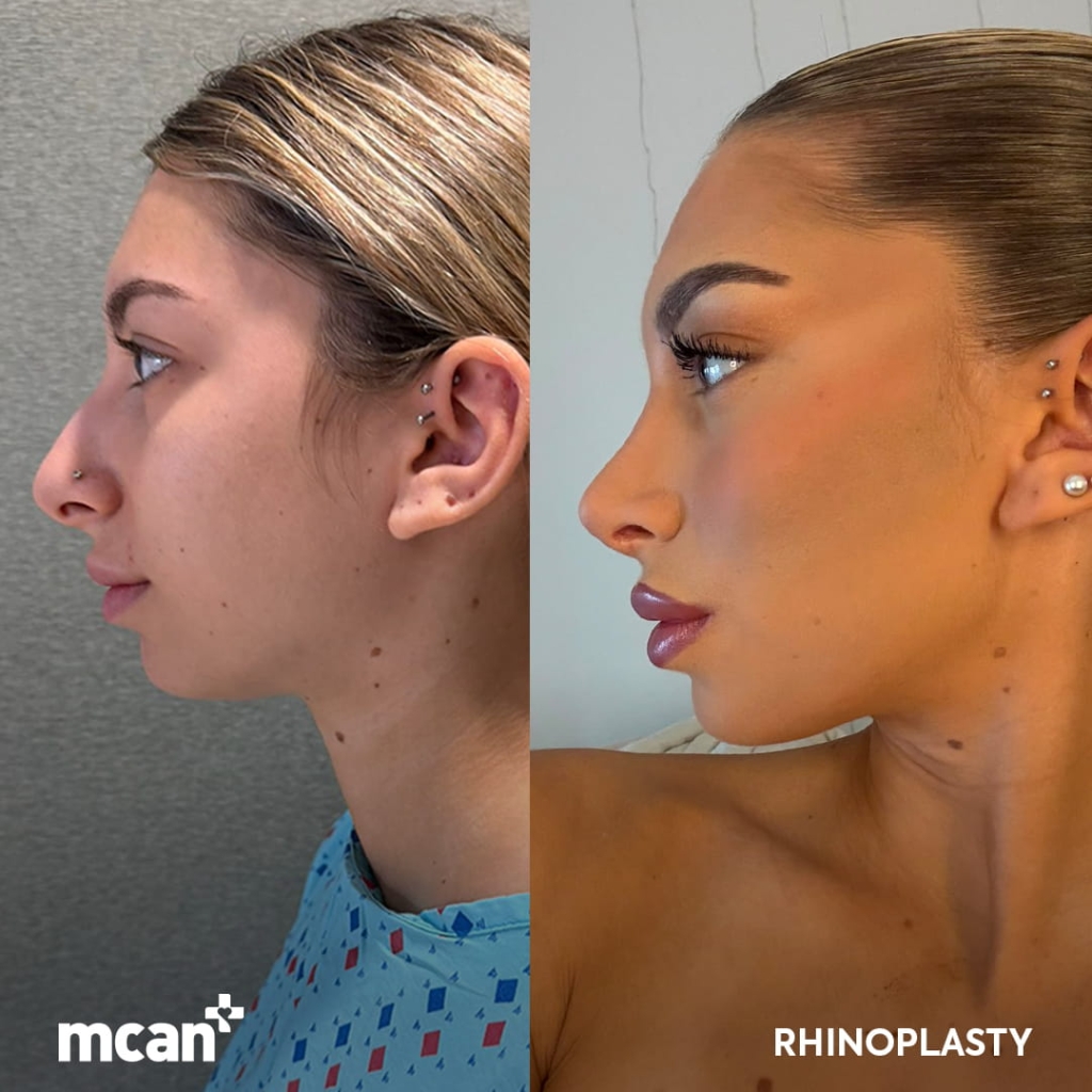 Rhinoplasty Turkey 4 Gioia g.parillo Gioia g.parillo