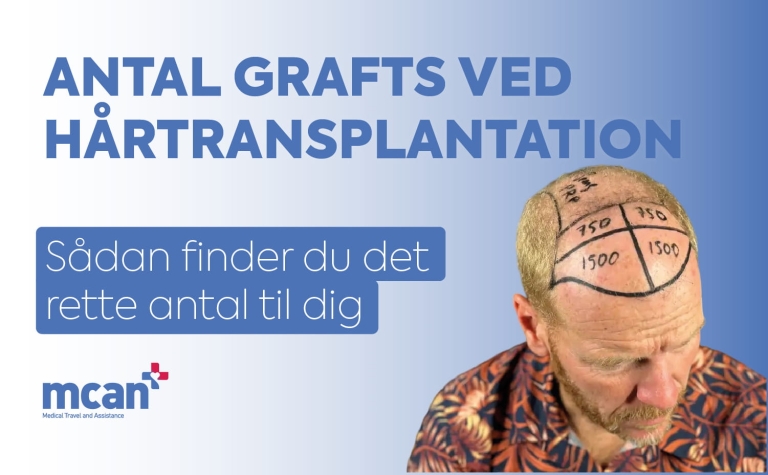 Antal grafts ved hårtransplantation: Sådan finder du det rette antal for dig 5 Hair Transplant Graft Counts da Hair Transplant Graft Counts da