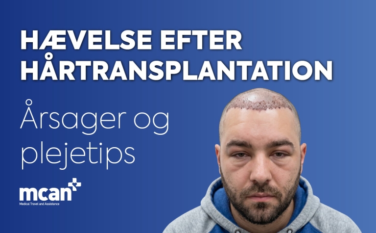 Hævelse efter hårtransplantation: Årsager og plejetips 11 Hair Transplant Swelling da 1 Hair Transplant Swelling da 1