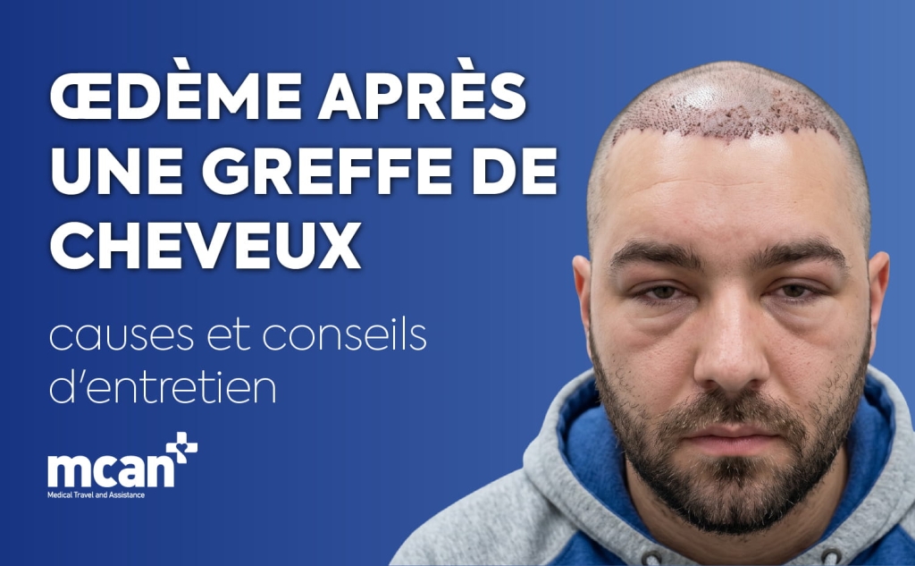 Hair Transplant Swelling de 1