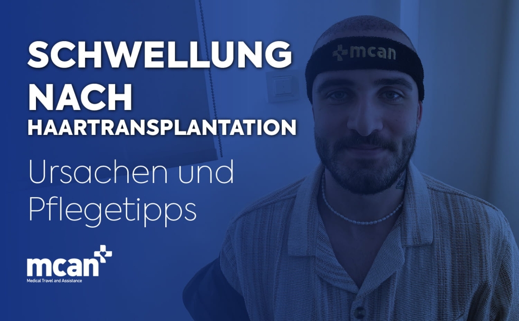 Hair Transplant Swelling es