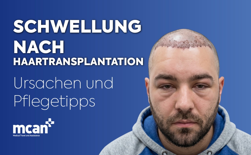 Hair Transplant Swelling es 2