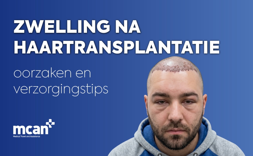 Hair Transplant Swelling fr 2