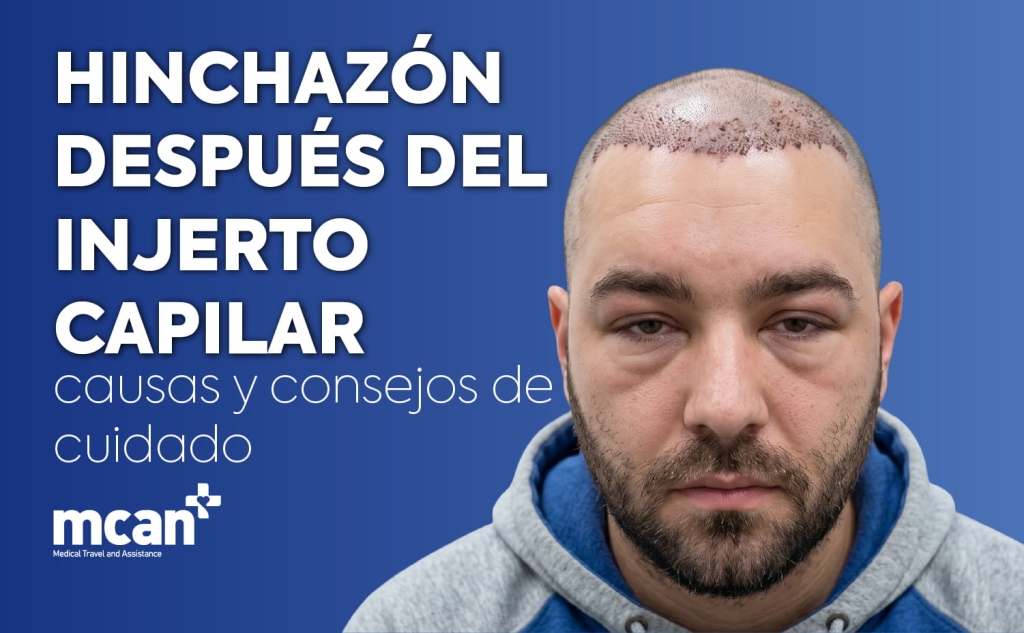 Hair Transplant Swelling nl 1