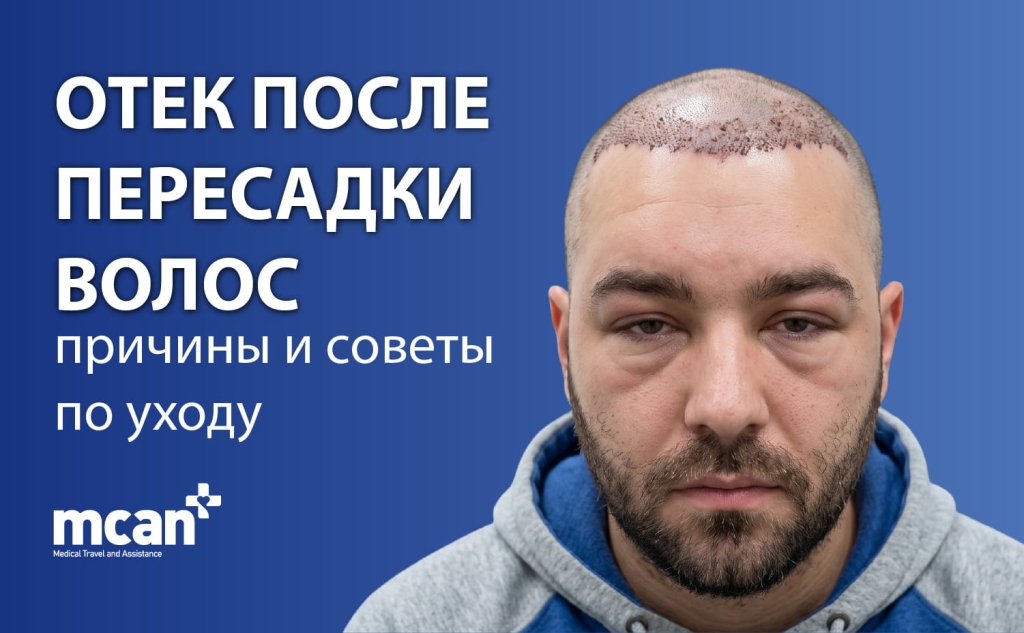 Отек после пересадки волос: причины и советы по уходу 1 Hair Transplant Swelling ru 1 Hair Transplant Swelling ru 1